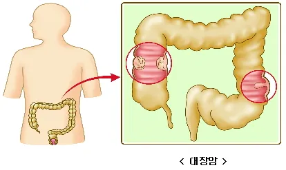 사진출처 서울성모병원