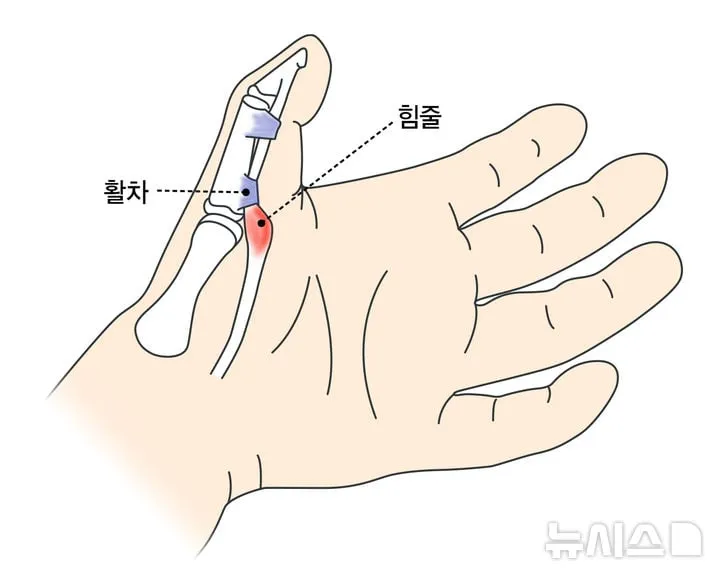 방아쇠 손가락 급증…스마트폰 과사용→손 건강 위협과 치료 분석