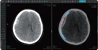 AI 뇌출혈 진단 혁신…제이엘케이, FDA 앞세워 북미 의료시장 진격→산업 지형 재편
