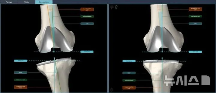 AI 수술플랫폼 혁신…연세사랑병원, 맞춤형 인공관절 시장 재정의